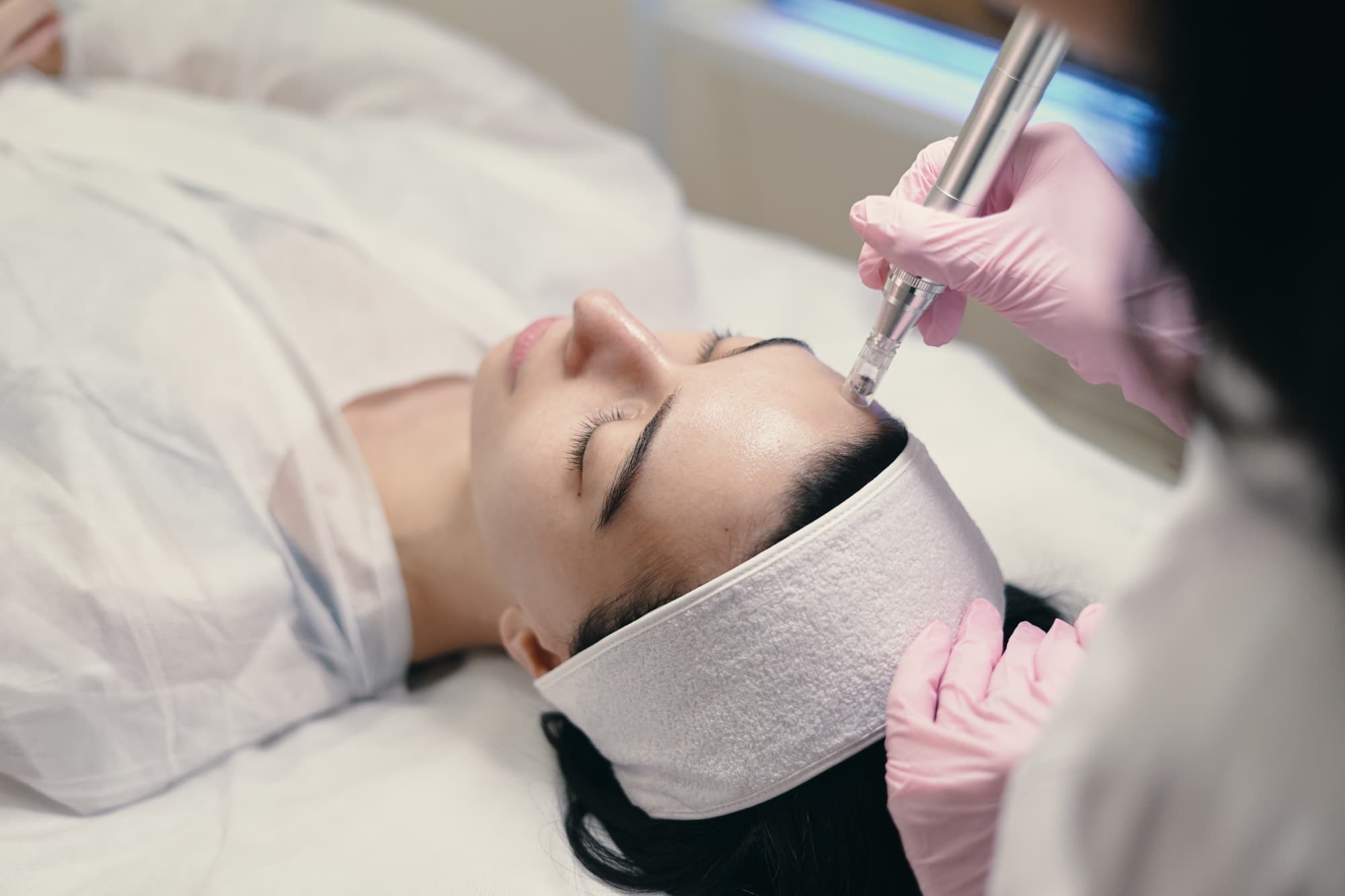 microneedle treatment on forehead
