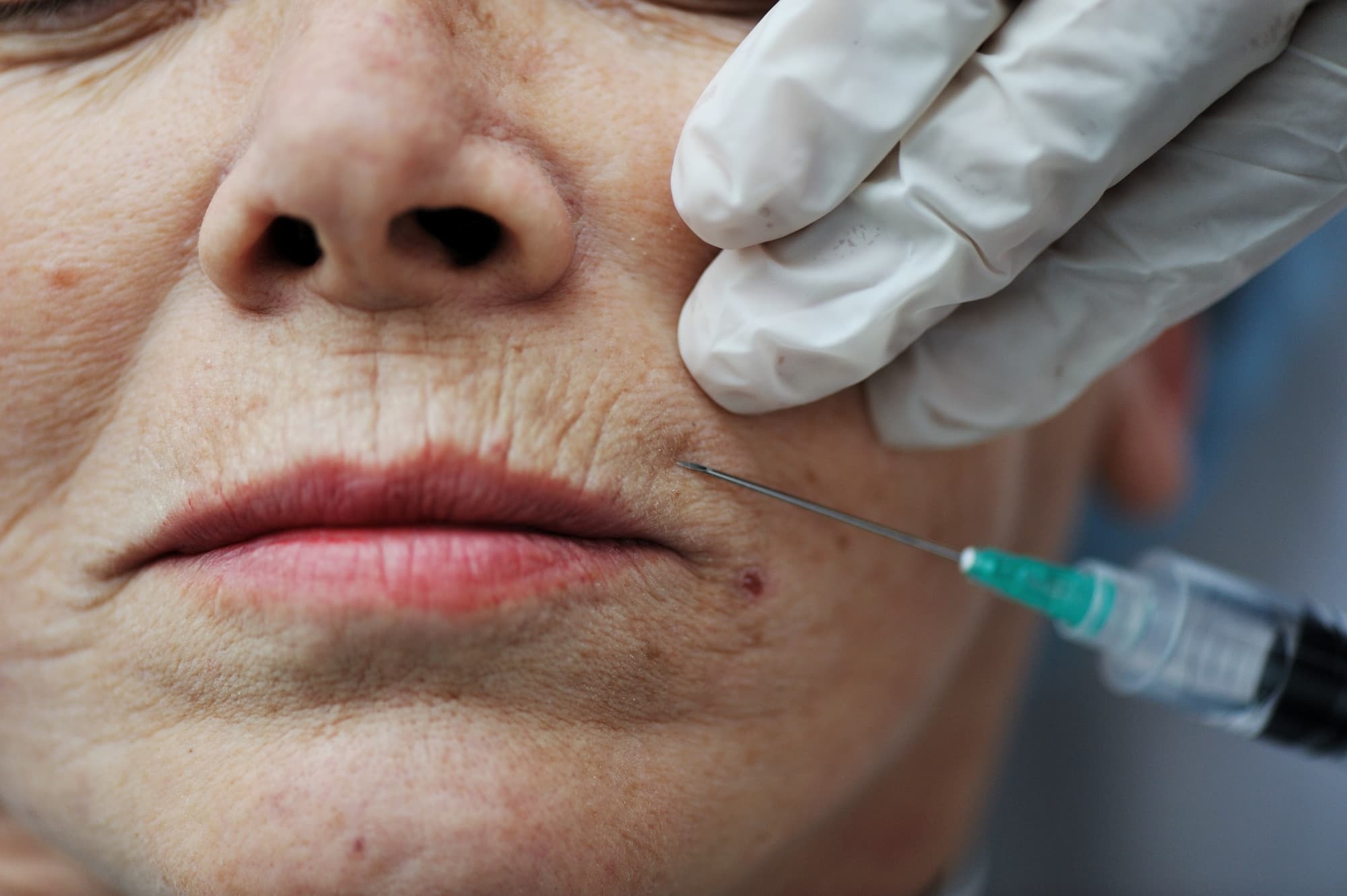 woman getting a lip wrinkle treatment