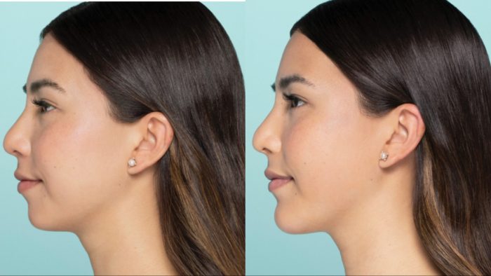 Female patient who received Restylane Defyne for chin augmentation.