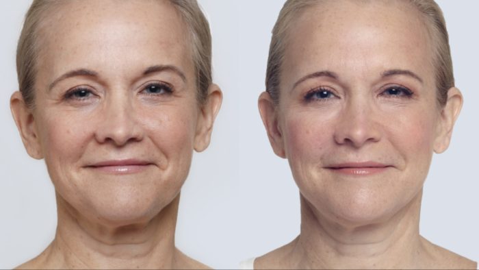 Female patient's before and after comparison with Restylane Lyft in the cheeks.