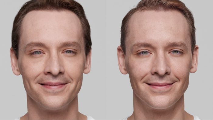 Male patient receiving various Restylane fillers to achieve facial rejuvenation.