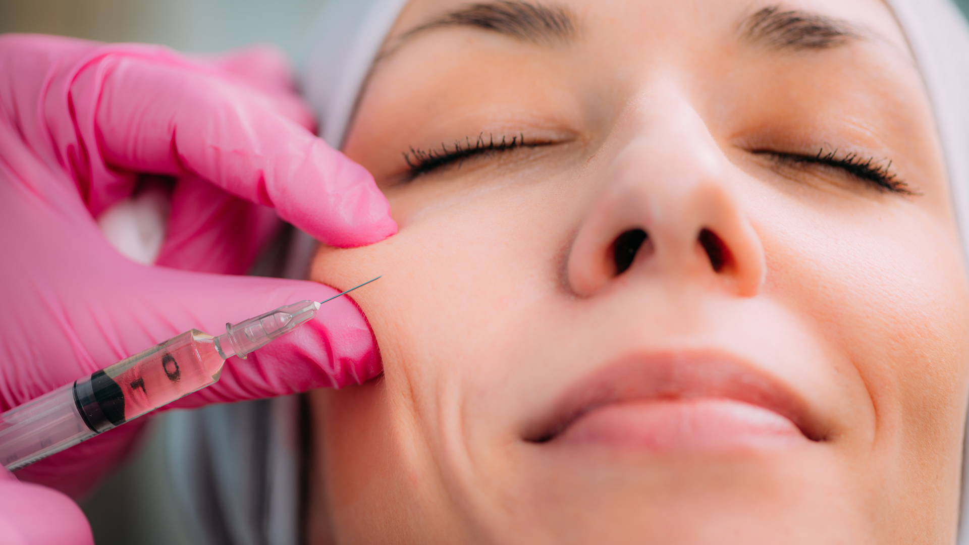 Woman getting Radiesse filler for face sculpting.
