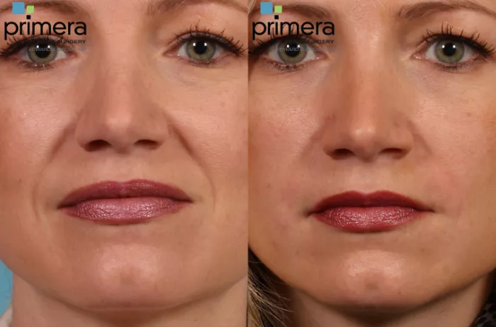 Woman with rejuvenated looks after Radiesse skin tightening.