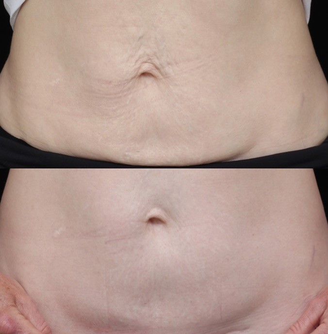 Radiesse injections to treat the abdomen