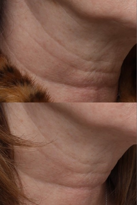 Radiesse for saggy neck skin.