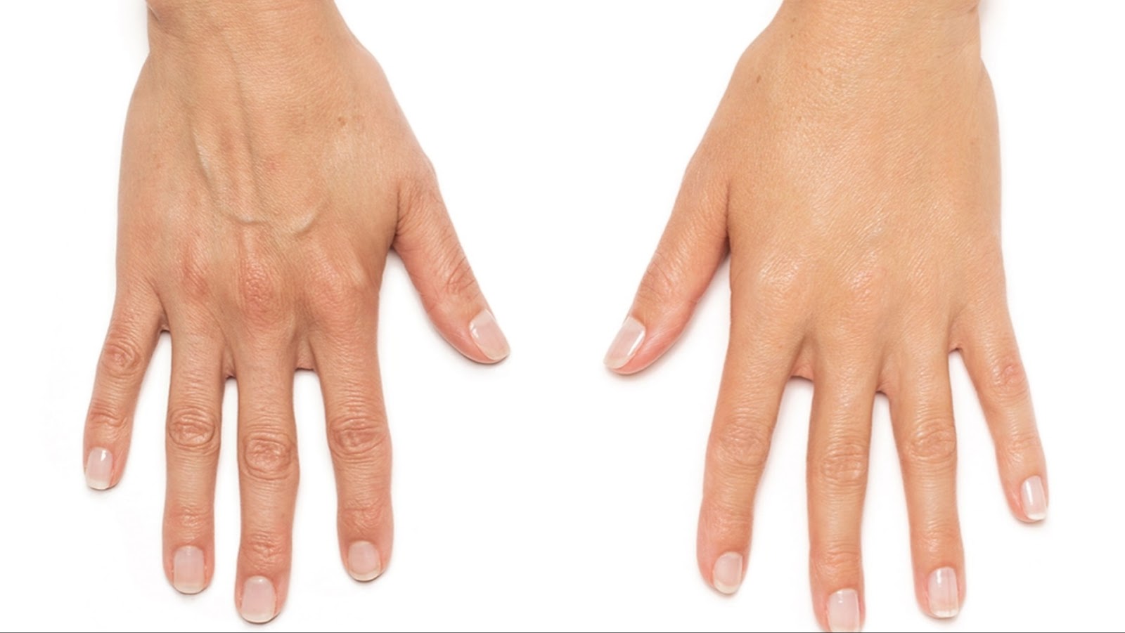 The difference between hands before and after using Radiesse.