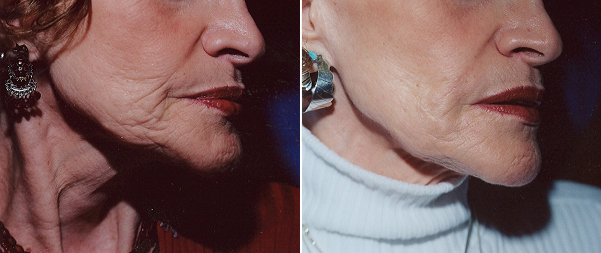 Before and after using Radiesse to address the soft jawline.