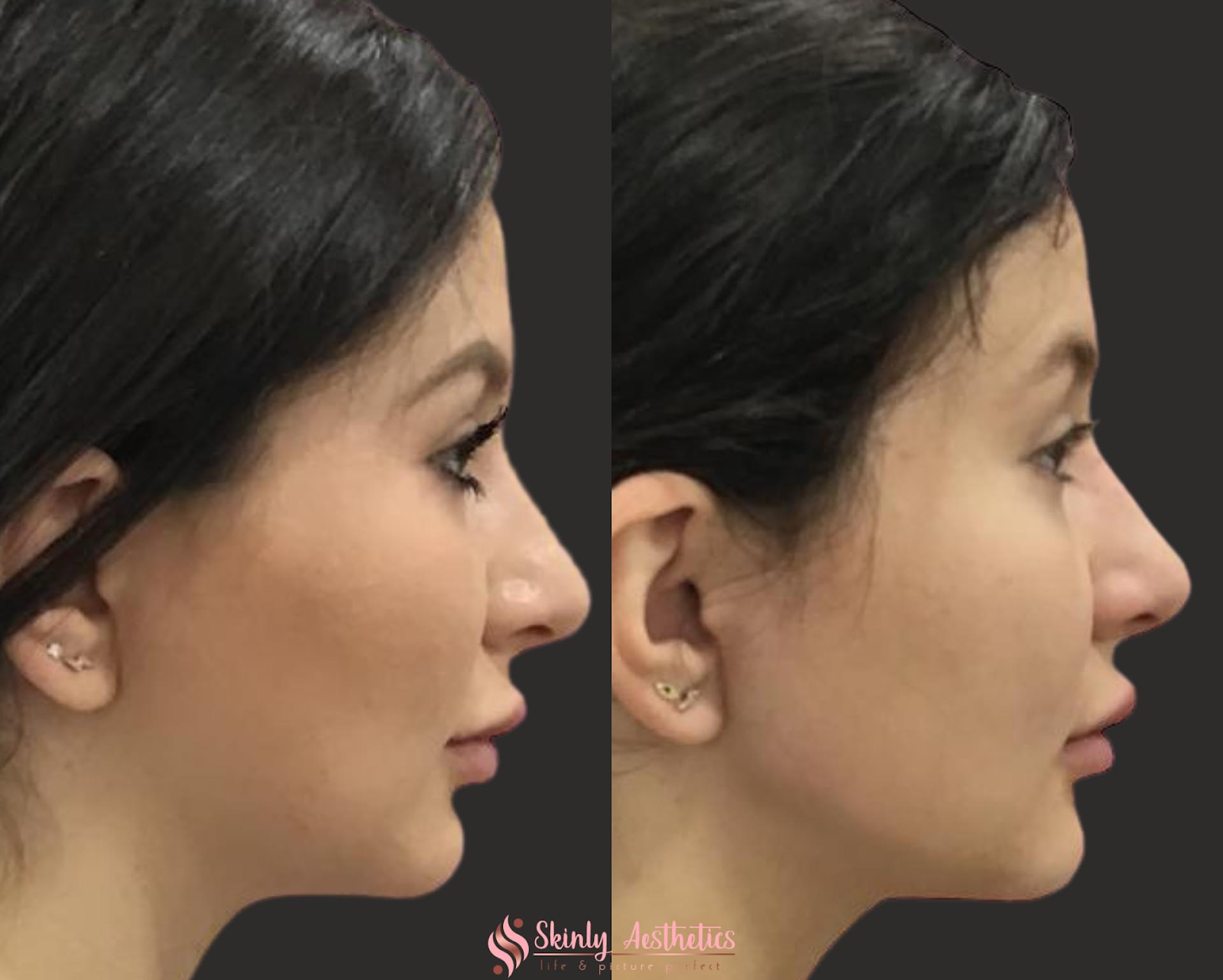 Before and after using combination treatments including Radiesse to enhance the jawline.