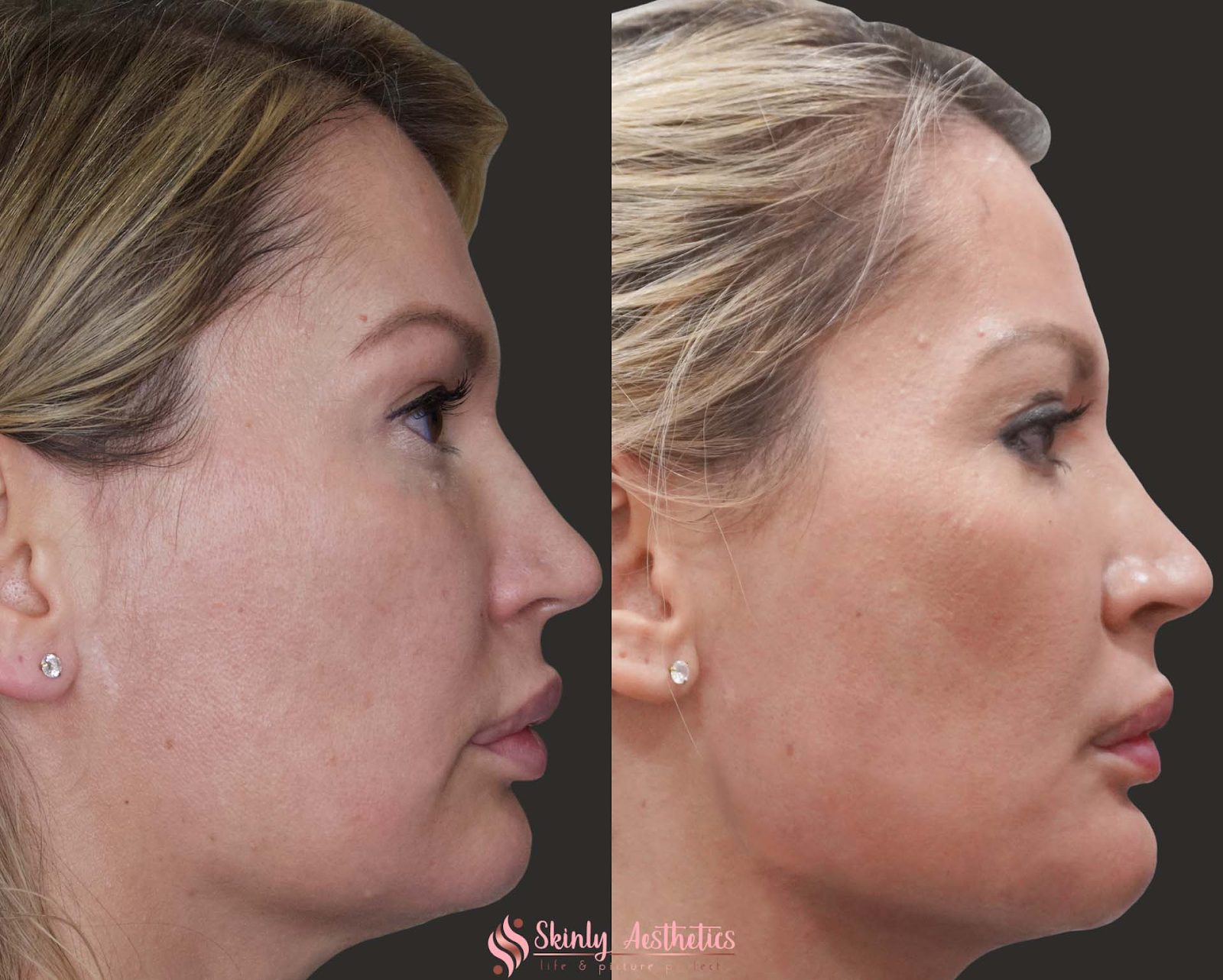 Before and after using Radiesse to define the jawline.