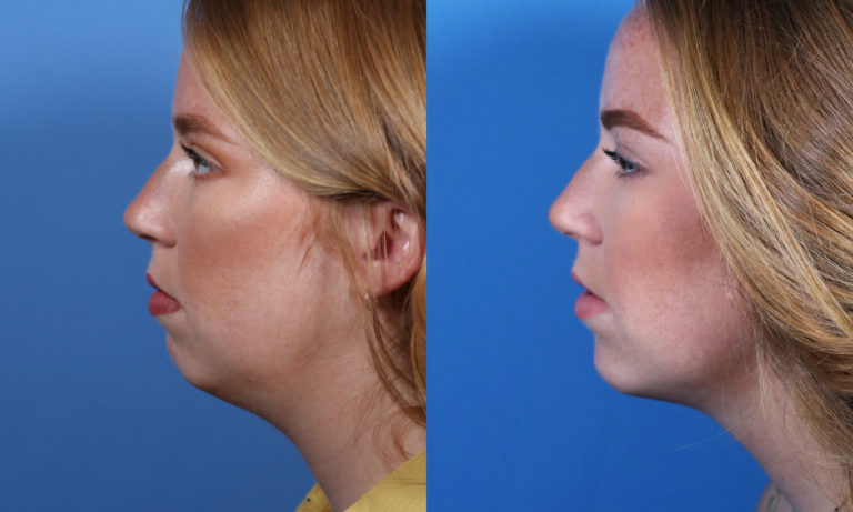Female patient's results after getting Radiesse to address her weak chin.