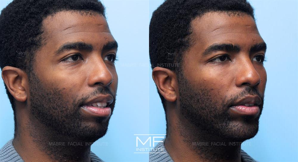 Male patient who received combination treatments, including Radiesse, to define his facial contours.