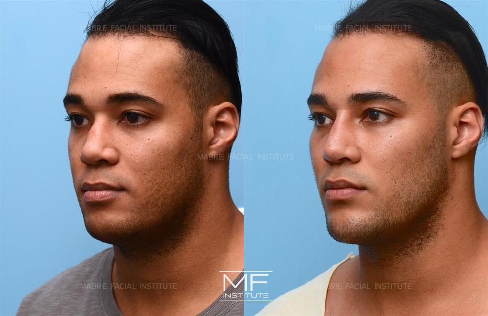 Male patient who received chin augmentation with Radiesse to enhance his appearance.